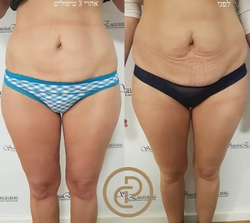 המסות שומן 6