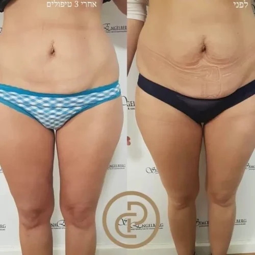 המסות שומן 6